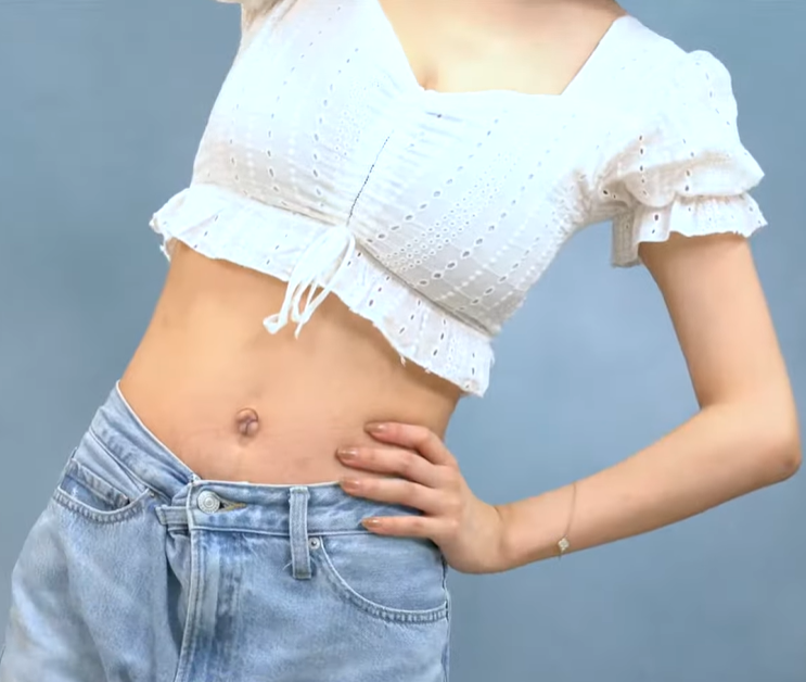 產後媽媽進行 Emsculpt Neo 產後體雕改善腹直肌分離