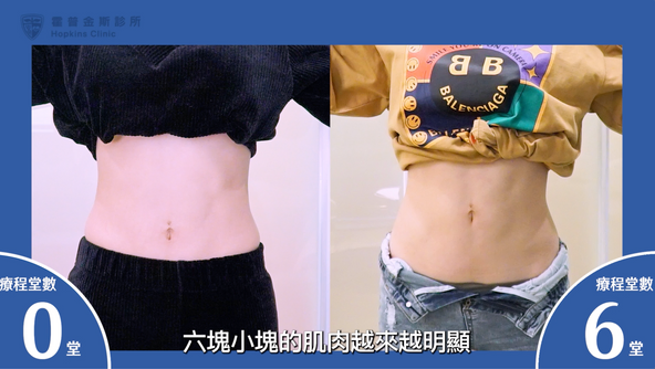 【影片見證】Chloe / 重訓搭配療程,讓我的腹肌更明顯了 3 00fa87 b89718335e3c4a72b11775f01e9dd168mv2