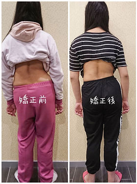 【見證】學生 彭妹妹 - 嚴重脊柱側彎 2 7e9946 8b9c36f6ccb649669be2f09dde436bf0mv2