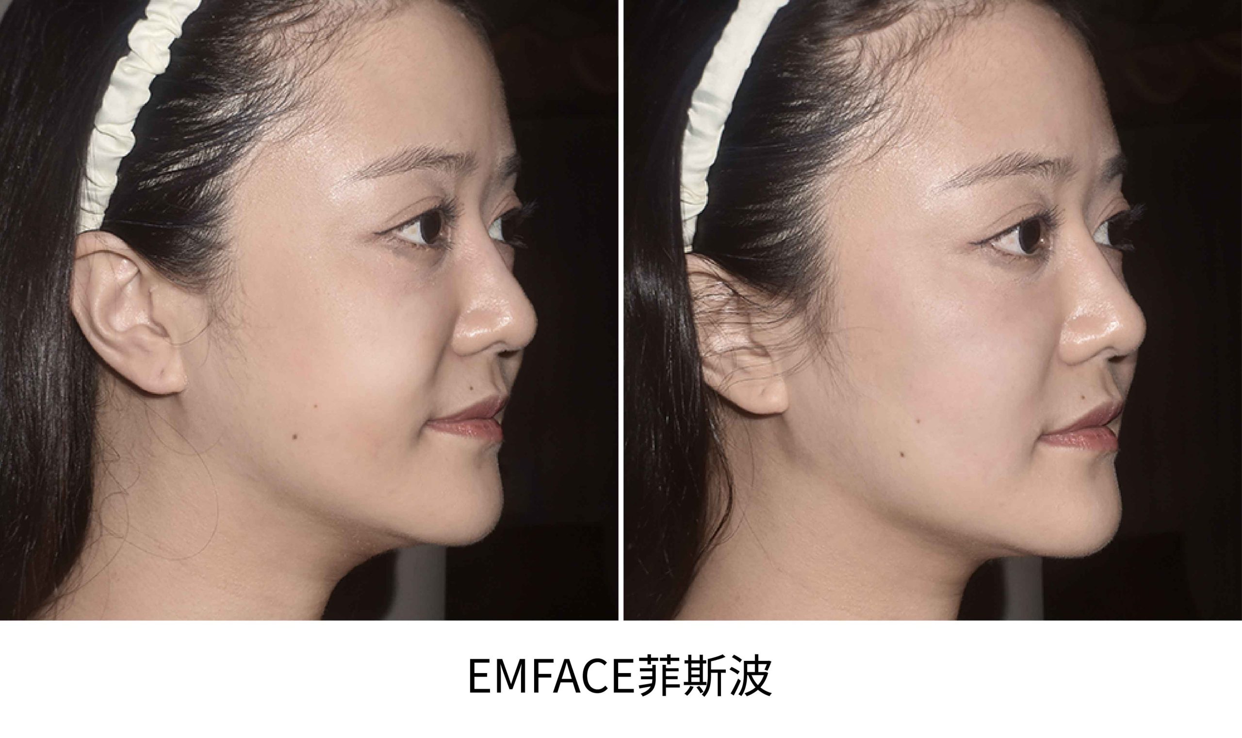 emface BA