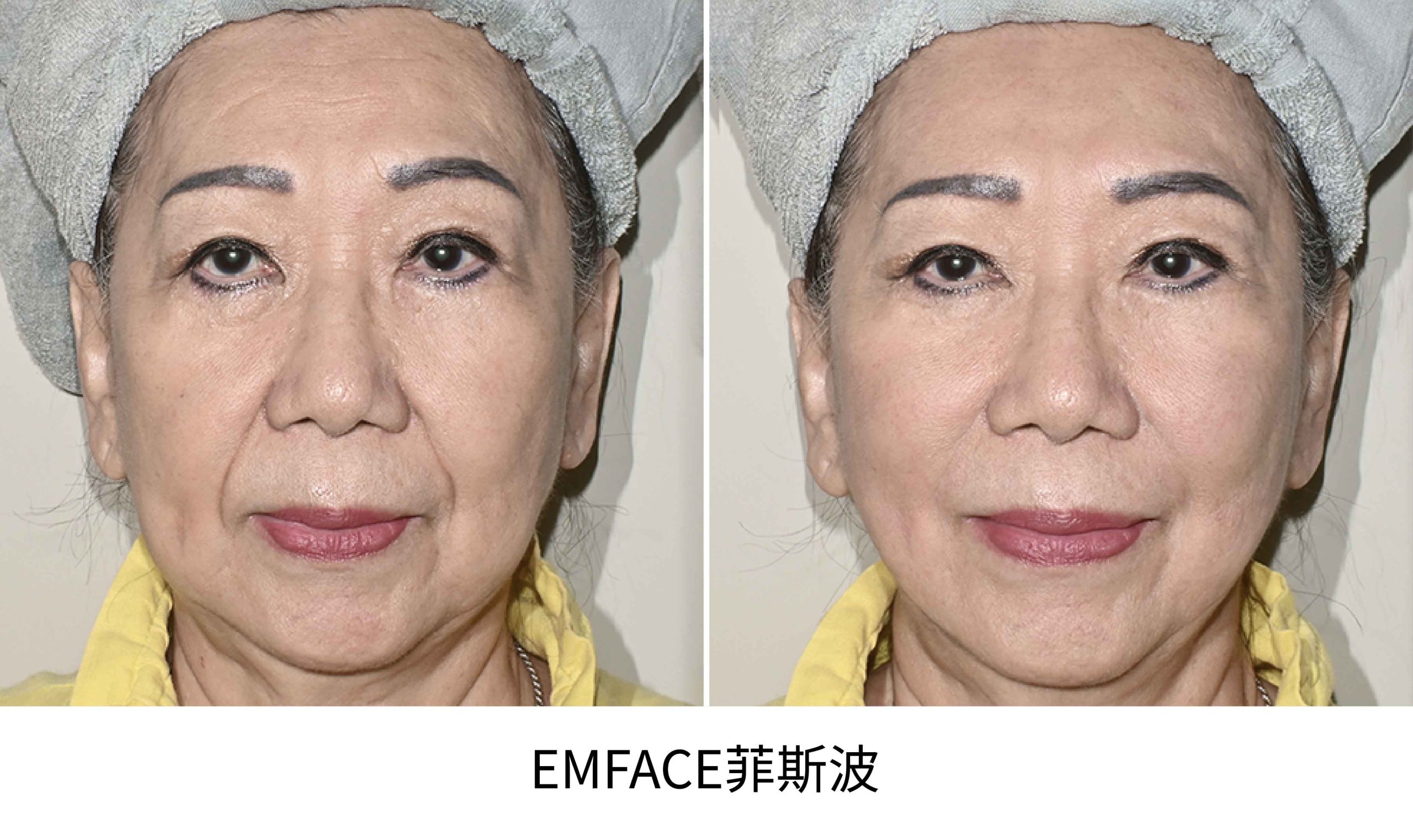 emface BA