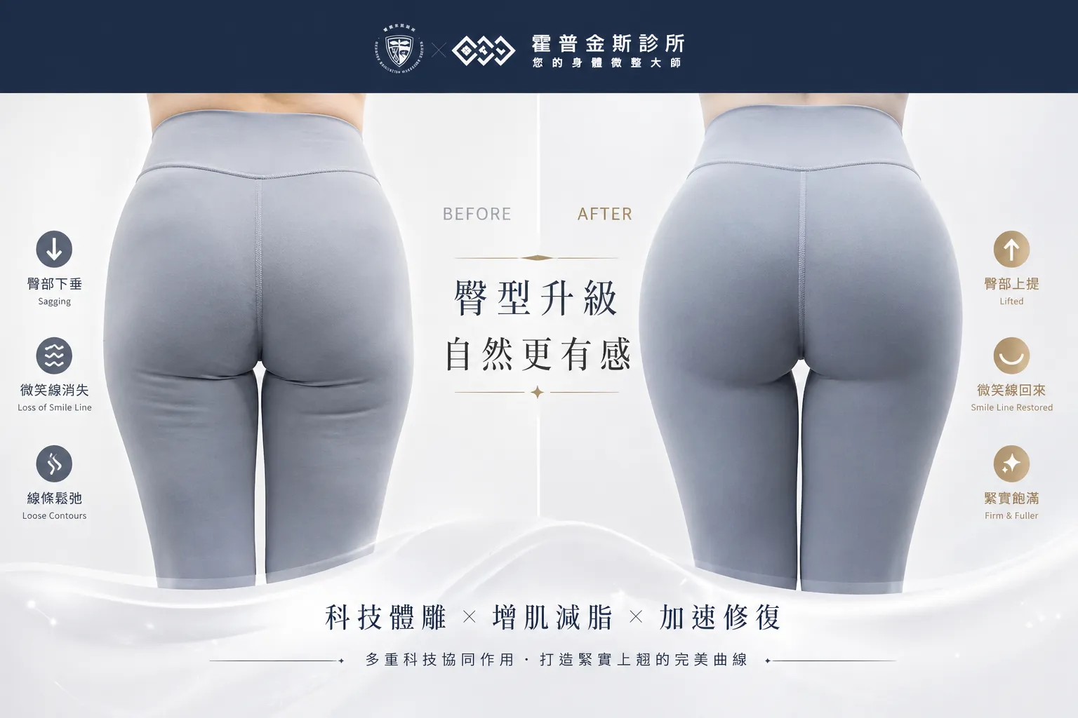 32歲久坐族接受SIS加NEO複合翹臀療程後，臀部微笑線上提與飽滿度改善成果照