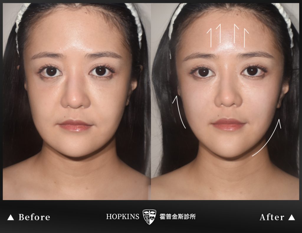 無痕雙效拉提施打前後對比照