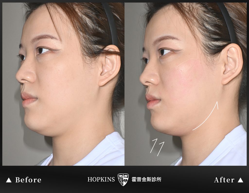 女性護理師 EMFACE 療程後自然改善臉部輪廓的效果呈現