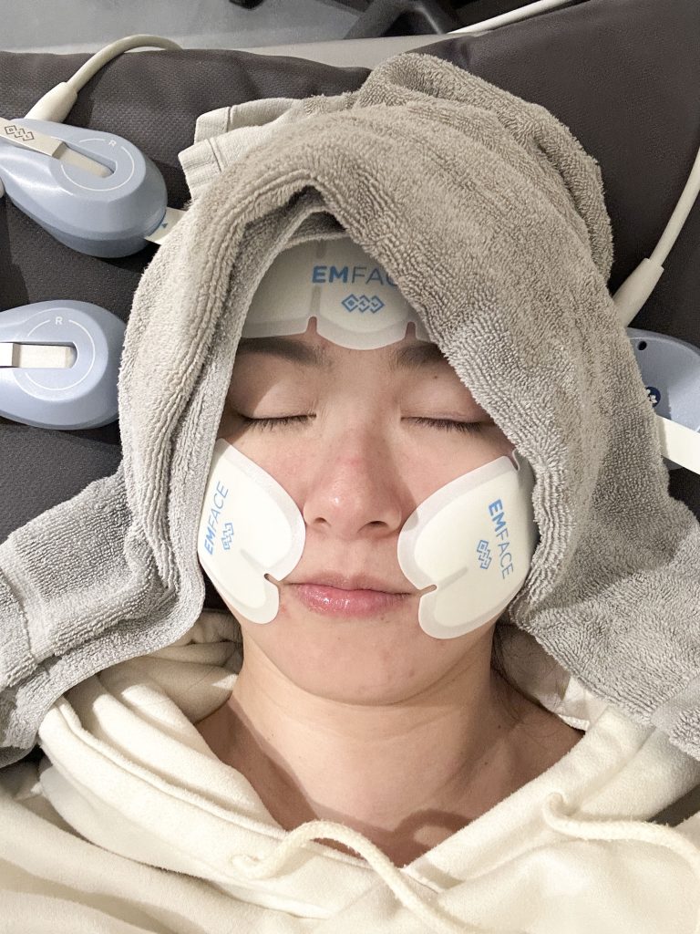 EMFACE菲斯波非侵入式臉部肌肉拉提療程與3D影像術後對比分析