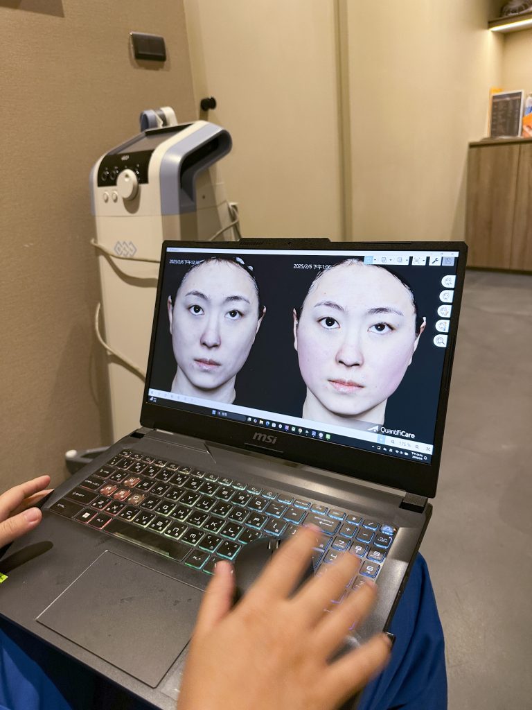 EMFACE菲斯波非侵入式臉部肌肉拉提療程與3D影像術後對比分析