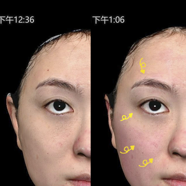 EMFACE菲斯波非侵入式臉部肌肉拉提療程與3D影像術後對比分析