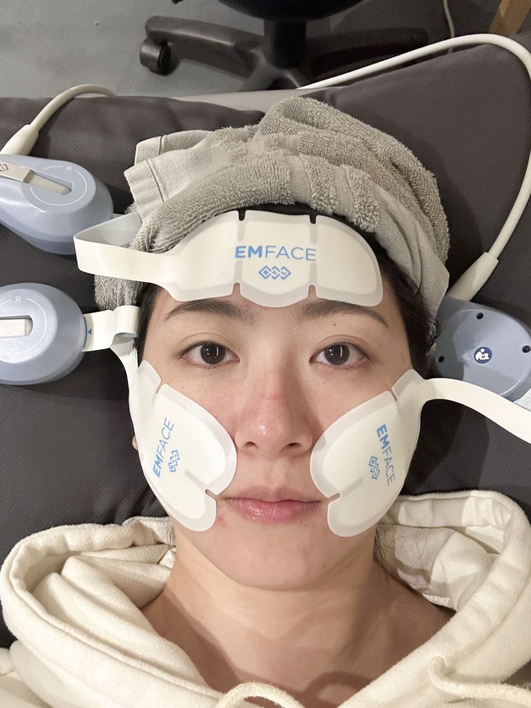 EMFACE菲斯波非侵入式臉部肌肉拉提療程與3D影像術後對比分析