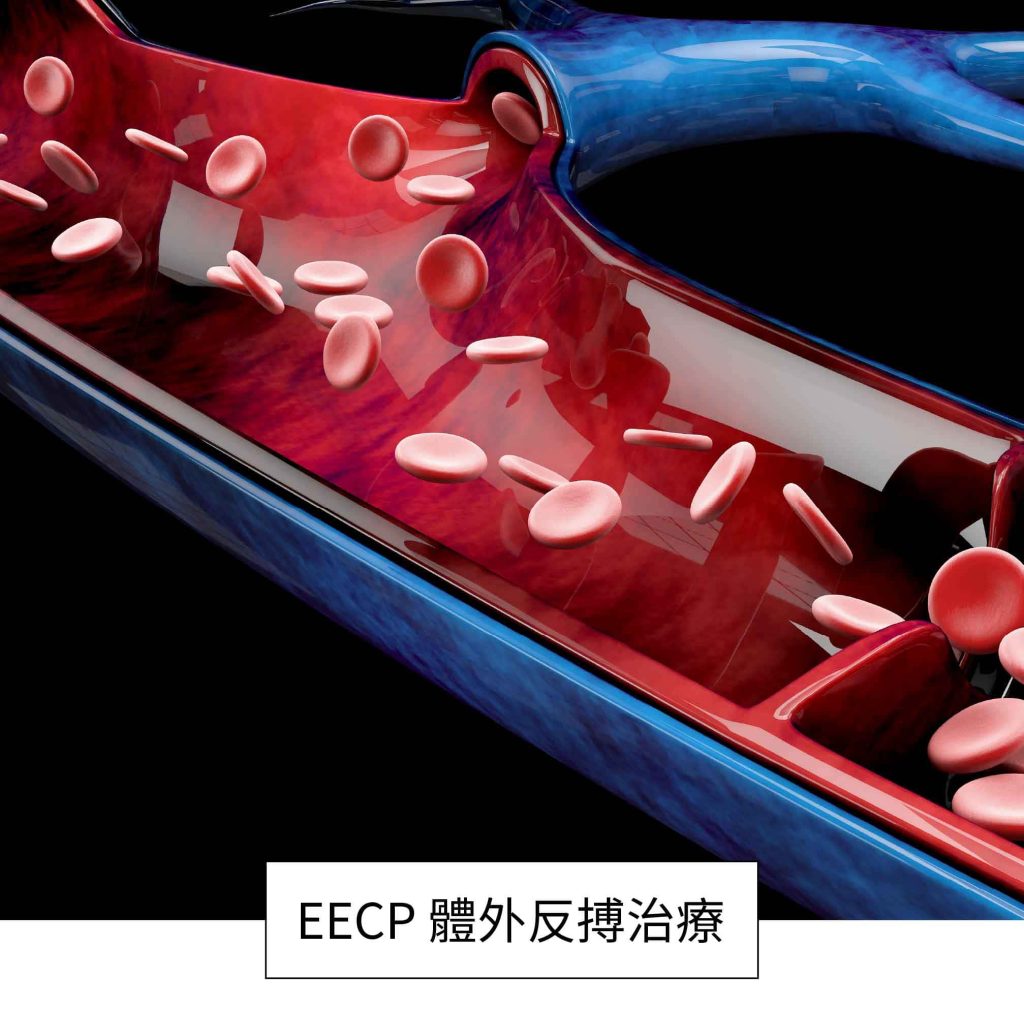 EECP體外反搏治療-增加血液回流刺激血管內釋放一氧化氮