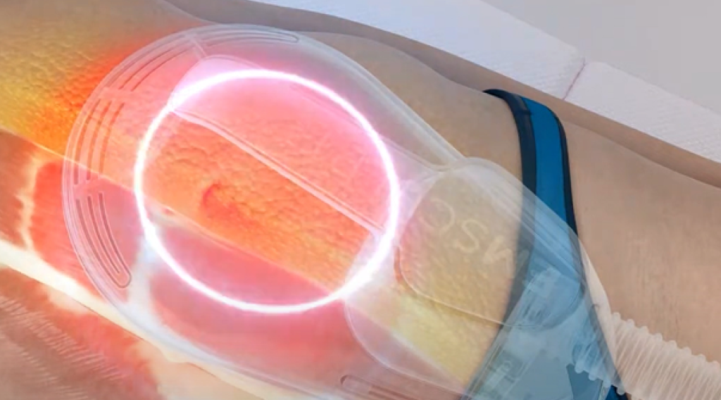 Emsculpt NEO熱磁減脂施作示意圖-RF電波熱能穿透皮下脂肪層與破壞脂肪細胞