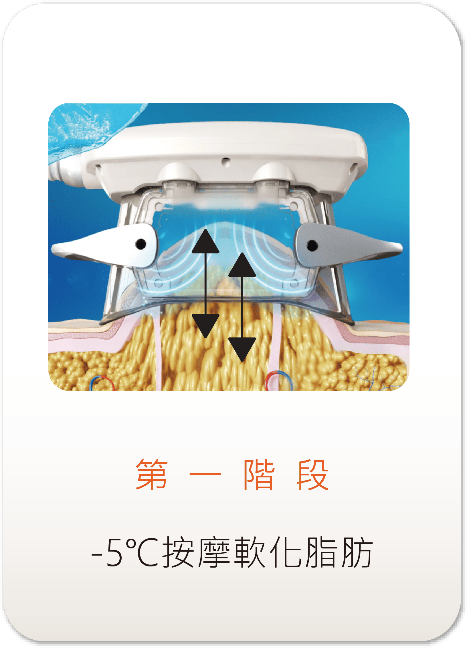 ZLipo Z塑酷冷凍減脂第一階段示意圖-5度C負壓按摩軟化頑固脂肪