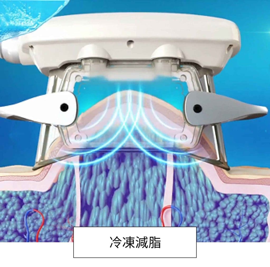 冷凍減脂治療以非侵入式低溫探頭精準消除皮下脂肪