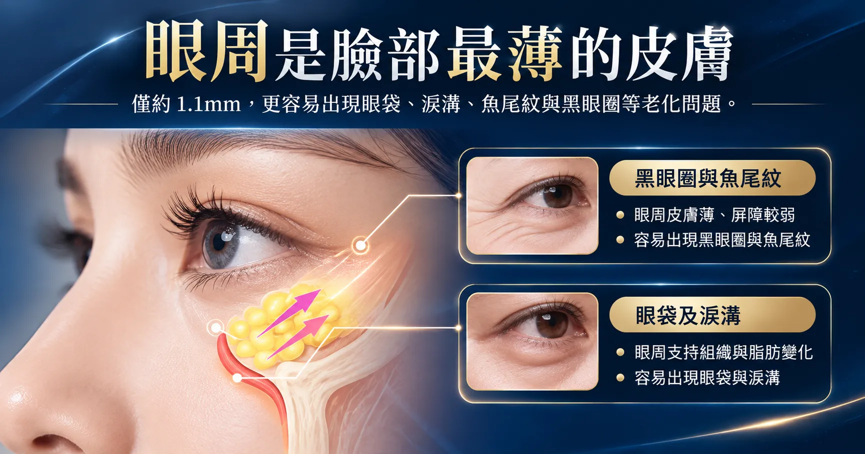EMFACE 眼周貼片是什麼?魚尾紋、眼袋、淚溝與療程安排一次了解 2 眼周肌膚老化示意圖,說明眼周皮膚較薄,以及魚尾紋、眼袋、淚溝和眼下暗沉等常見問題的不同成因與評估重點。