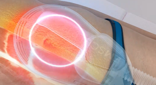 Emsculpt NEO熱磁減脂施作示意圖-RF電波熱能穿透皮下脂肪層與破壞脂肪細胞