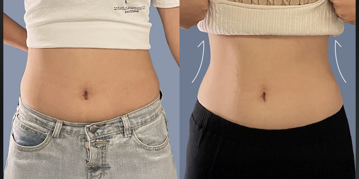 MitoX 粒線體燃脂減重、NEO熱磁減脂施作後改善效果