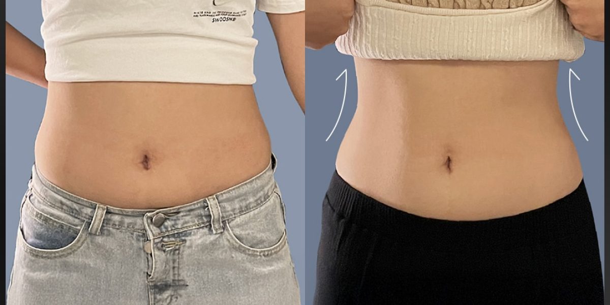 MitoX 粒線體燃脂減重、NEO熱磁減脂施作後改善效果